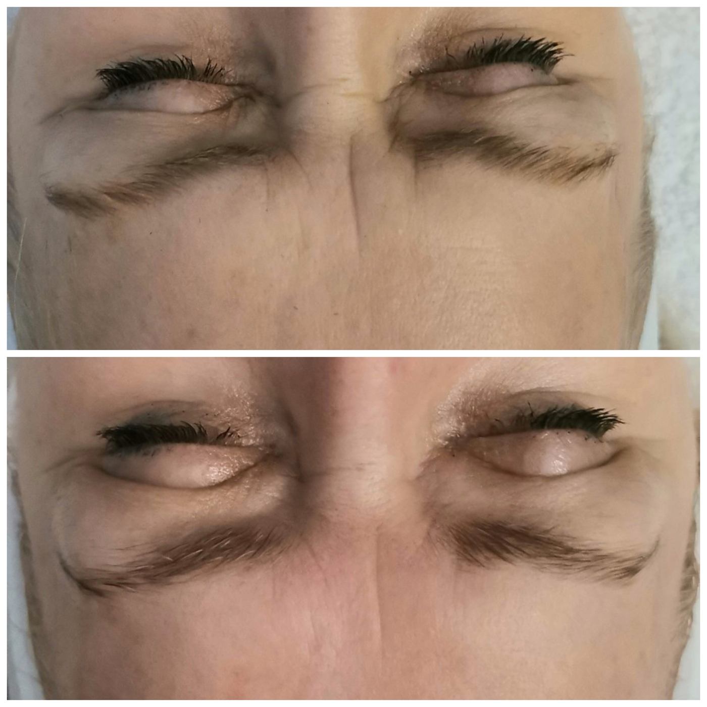 Vivena Massage before and after — cheek lift and skin firming results